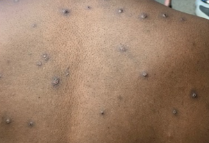 In the picture we can see what a monkeypox rash looks like